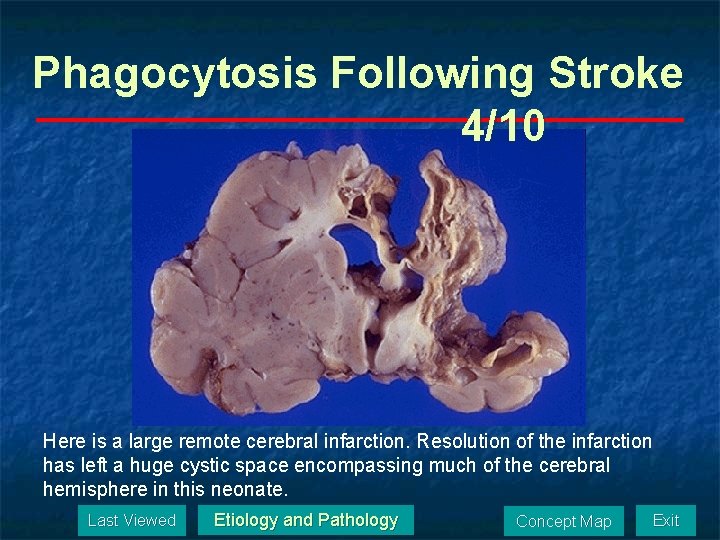 Phagocytosis Following Stroke 4/10 Here is a large remote cerebral infarction. Resolution of the