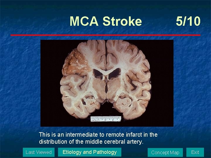 MCA Stroke 5/10 This is an intermediate to remote infarct in the distribution of