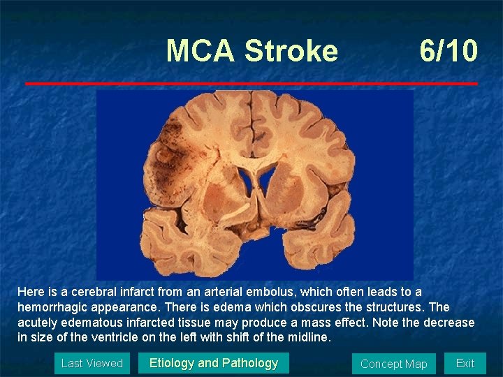 MCA Stroke 6/10 Here is a cerebral infarct from an arterial embolus, which often