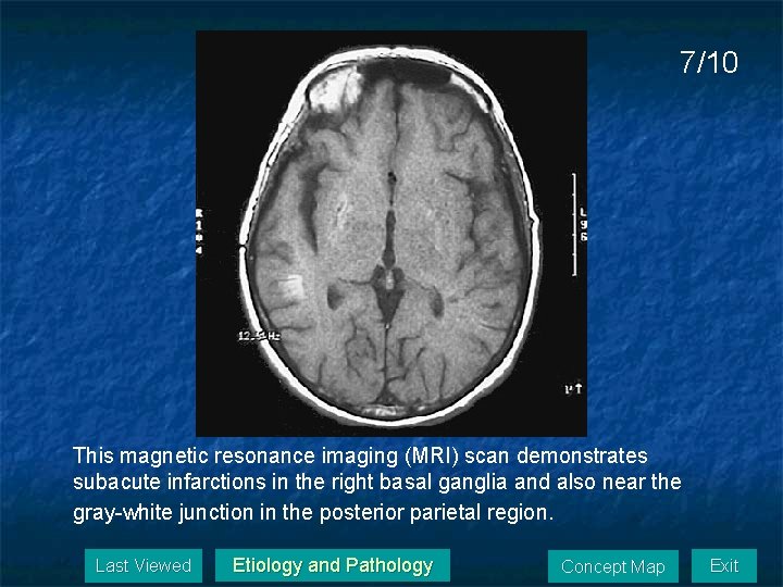 7/10 This magnetic resonance imaging (MRI) scan demonstrates subacute infarctions in the right basal