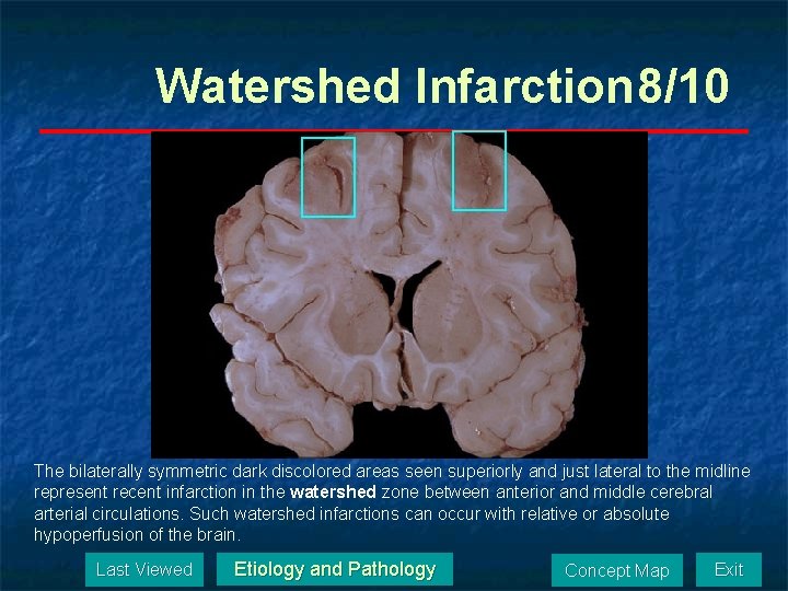 Watershed Infarction 8/10 The bilaterally symmetric dark discolored areas seen superiorly and just lateral