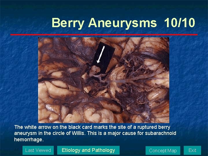Berry Aneurysms 10/10 The white arrow on the black card marks the site of