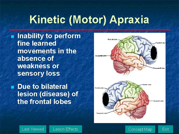 Kinetic (Motor) Apraxia n Inability to perform fine learned movements in the absence of