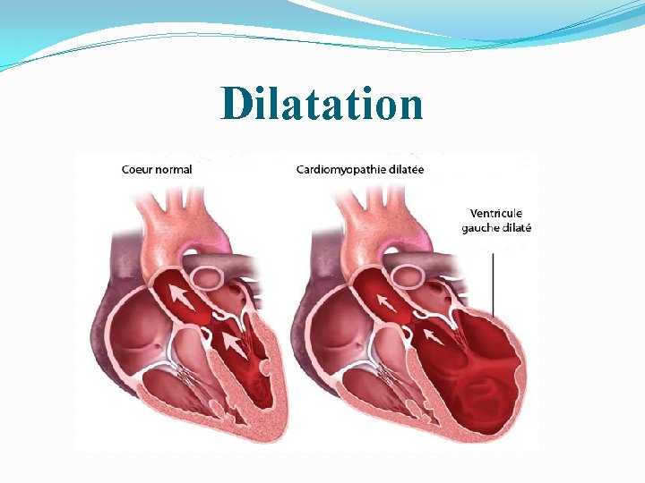 Dilatation 