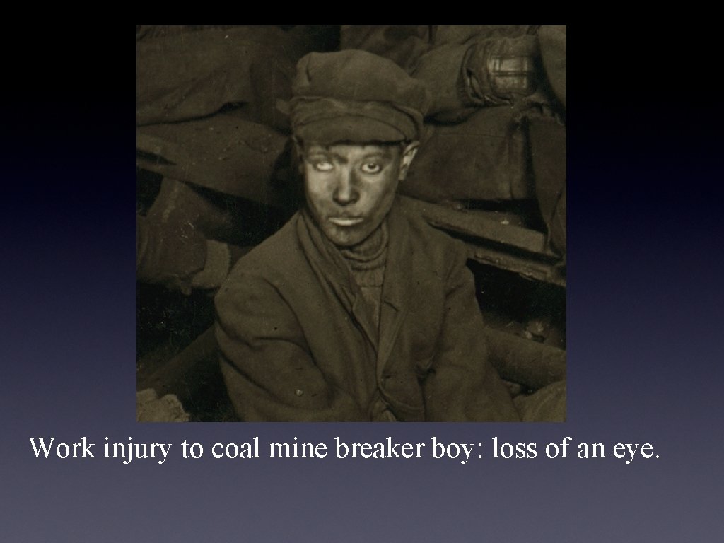 Work injury to coal mine breaker boy: loss of an eye. Work injury to coal mine breaker boy: loss of an eye.