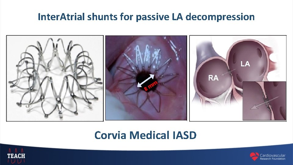 Inter. Atrial shunts for passive LA decompression m m 8 Corvia Medical IASD 