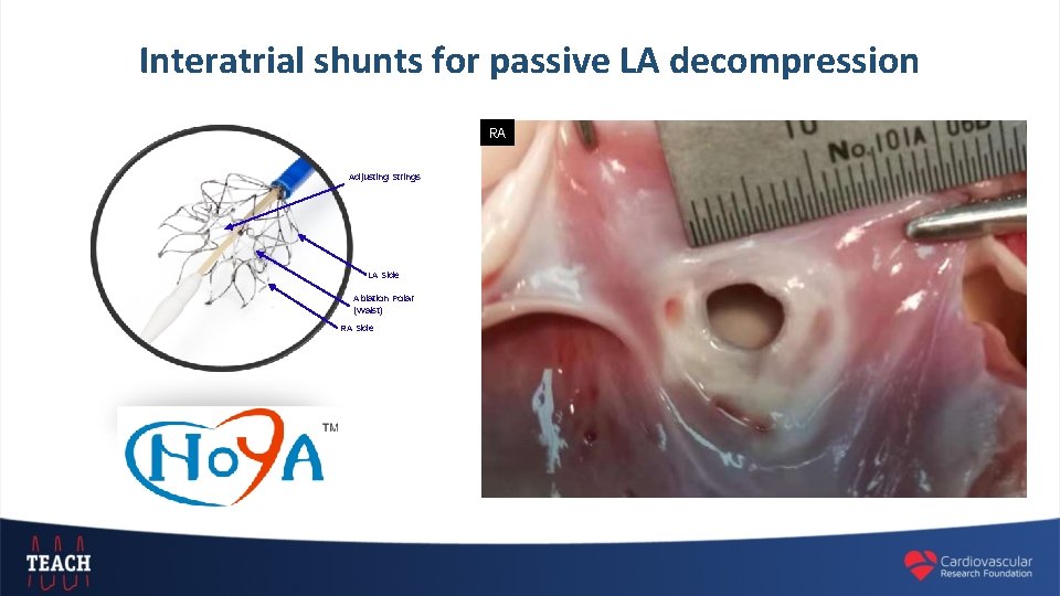 Interatrial shunts for passive LA decompression RA Adjusting Strings LA Side Ablation Polar (Waist)
