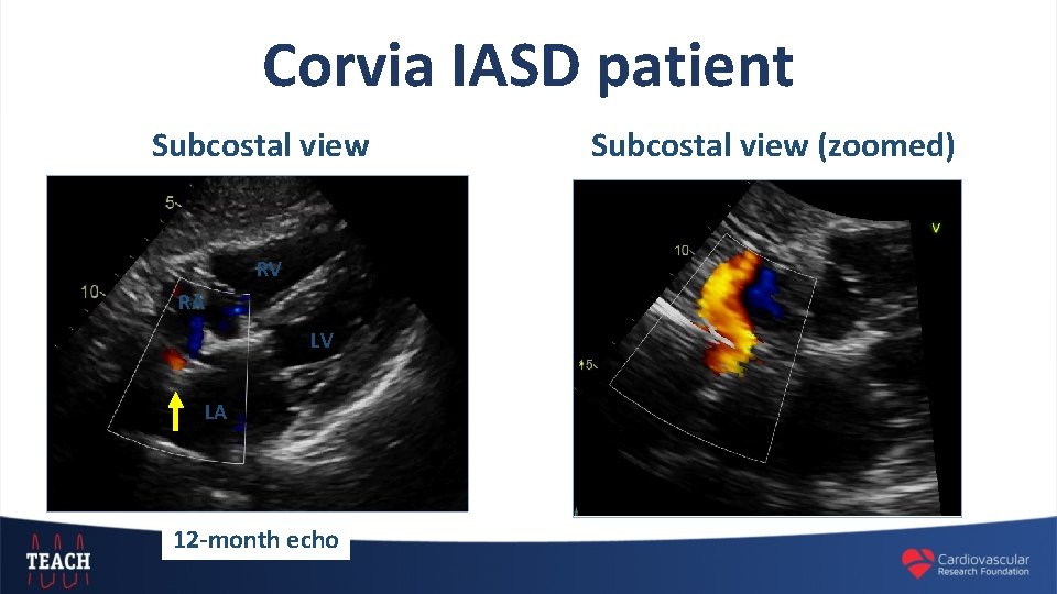 Corvia IASD patient Subcostal view RV RA LV LA 12 -month echo Subcostal view