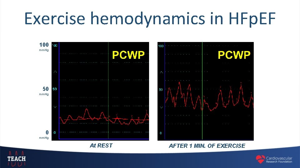Exercise hemodynamics in HFp. EF 100 mm. Hg 50 mm. Hg At REST AFTER