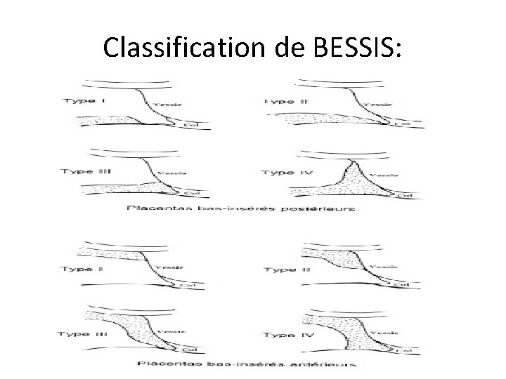 Classification de BESSIS: 