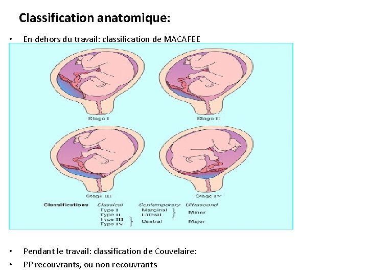 Classification anatomique: • En dehors du travail: classification de MACAFEE • • Pendant le
