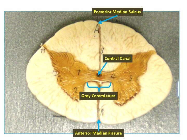 Posterior Median Sulcus Central Canal Grey Commissure Anterior Median Fissure 