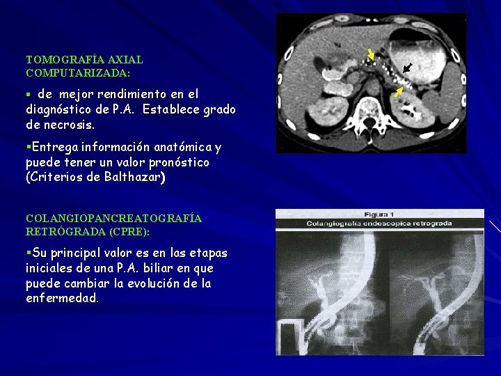 TOMOGRAFÍA AXIAL COMPUTARIZADA: § de mejor rendimiento en el diagnóstico de P. A. Establece