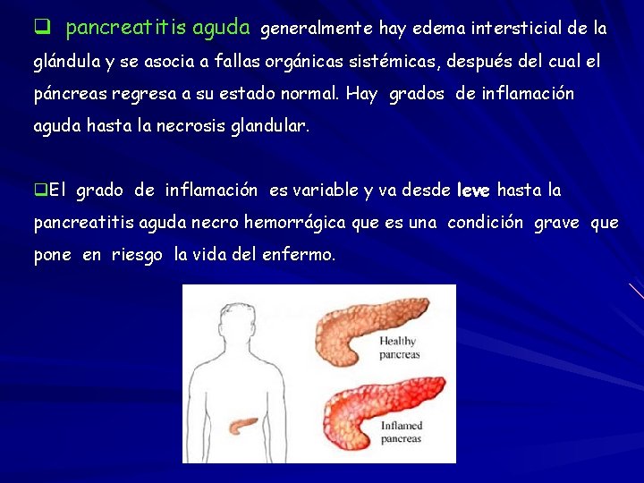 q pancreatitis aguda generalmente hay edema intersticial de la glándula y se asocia a