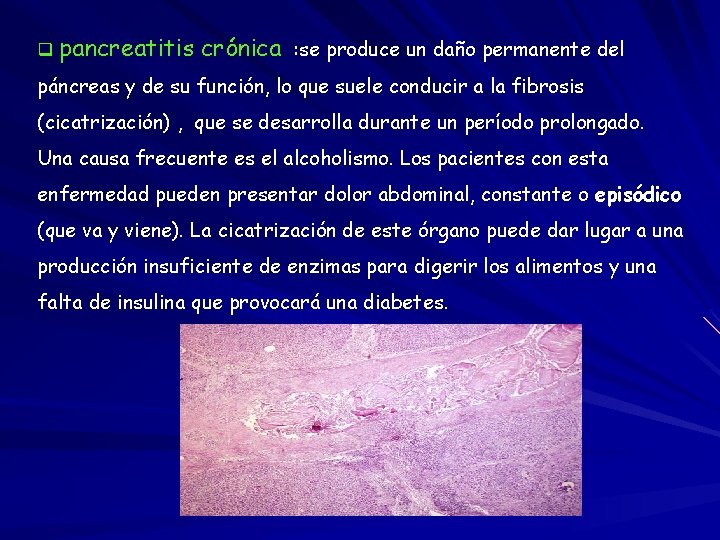 q pancreatitis crónica : se produce un daño permanente del páncreas y de su