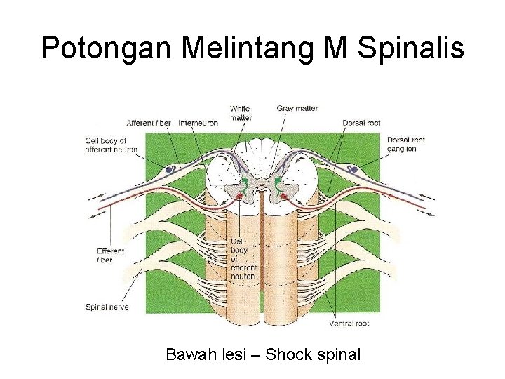 Potongan Melintang M Spinalis Bawah lesi – Shock spinal Potongan Melintang M Spinalis Bawah lesi – Shock spinal