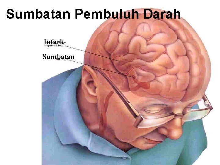 Sumbatan Pembuluh Darah Infark Sumbatan Sumbatan Pembuluh Darah Infark Sumbatan