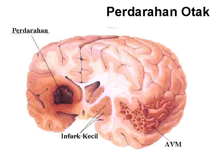 Perdarahan Otak Perdarahan Infark Kecil AVM Perdarahan Otak Perdarahan Infark Kecil AVM
