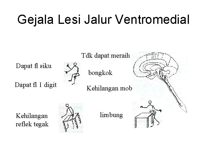 Gejala Lesi Jalur Ventromedial Tdk dapat meraih Dapat fl siku Dapat fl 1 digit Gejala Lesi Jalur Ventromedial Tdk dapat meraih Dapat fl siku Dapat fl 1 digit