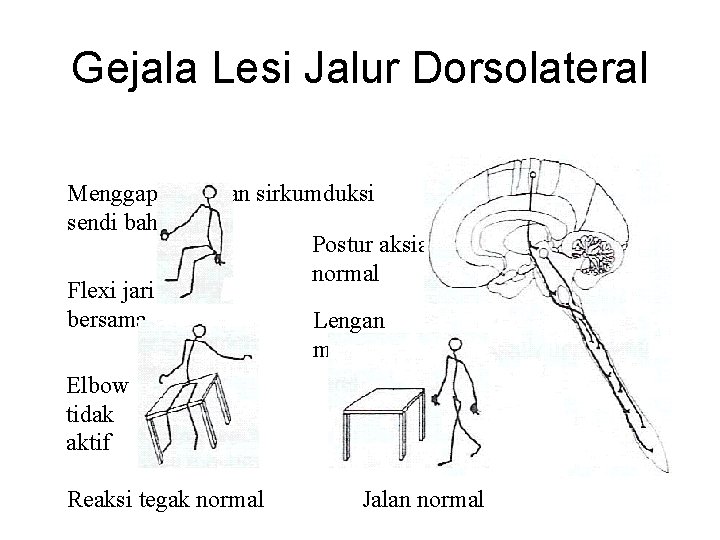 Gejala Lesi Jalur Dorsolateral Menggapai dengan sirkumduksi sendi bahu Postur aksial normal Flexi jari Gejala Lesi Jalur Dorsolateral Menggapai dengan sirkumduksi sendi bahu Postur aksial normal Flexi jari