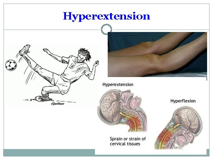 Hyperextension 