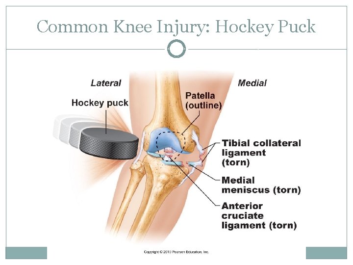 Common Knee Injury: Hockey Puck 