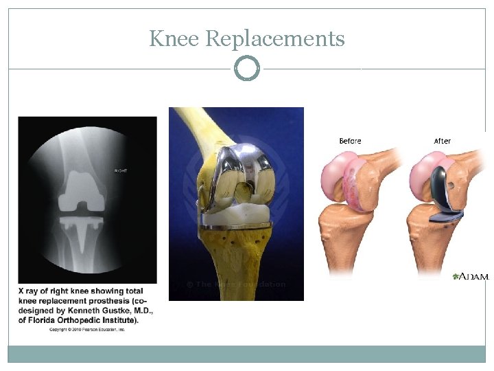 Knee Replacements Knee Replacements