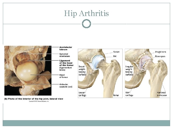 Hip Arthritis 