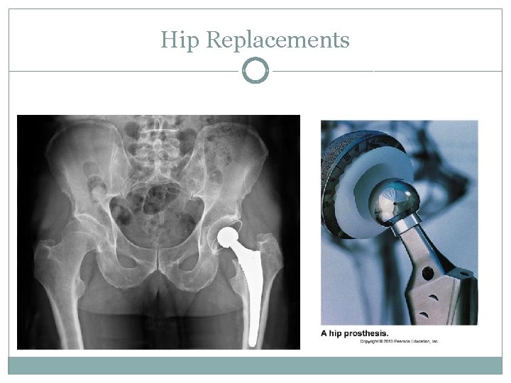 Hip Replacements Hip Replacements