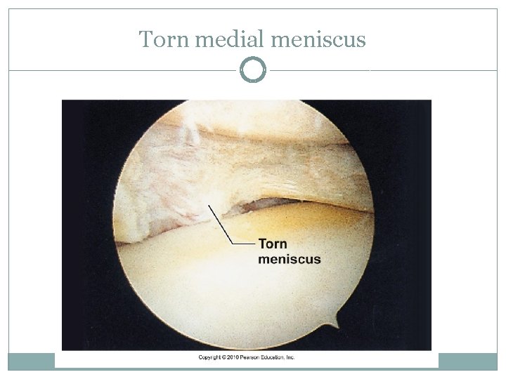 Torn medial meniscus Torn medial meniscus