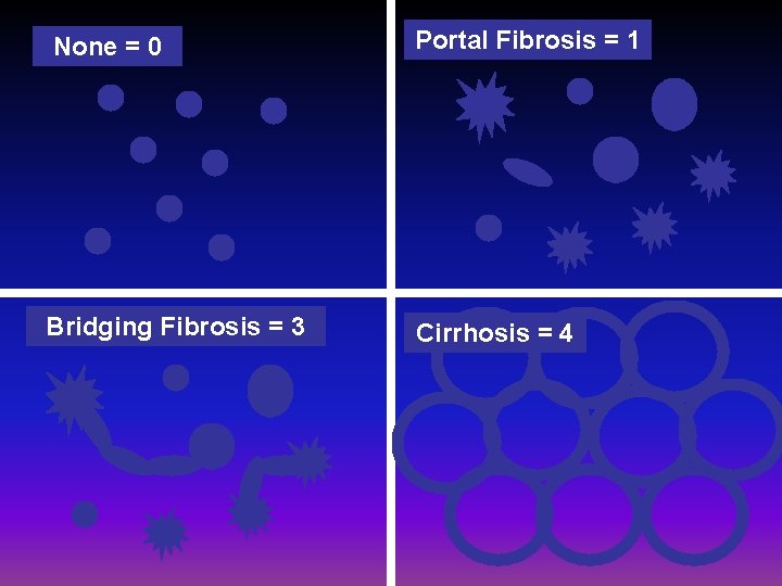 None = 0 Portal Fibrosis = 1 Bridging Fibrosis = 3 Cirrhosis = 4