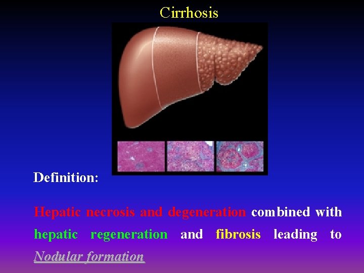 Cirrhosis Definition: Hepatic necrosis and degeneration combined with hepatic regeneration and fibrosis leading to