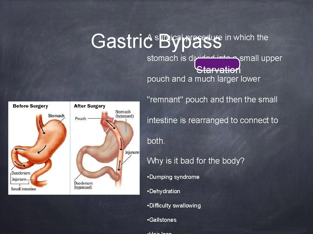 Gastric Bypass A surgical procedure in which the stomach is divided into a small