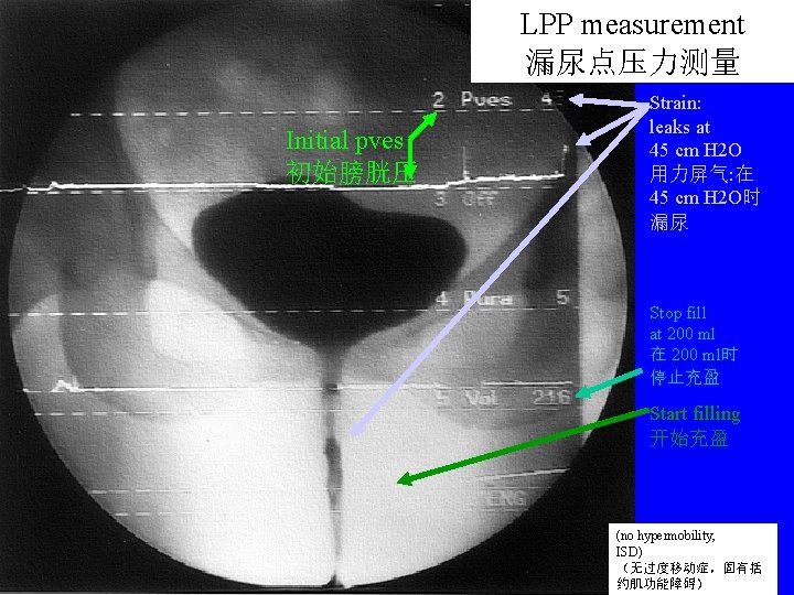 LPP measurement 漏尿点压力测量 Initial pves 初始膀胱压 Strain: leaks at 45 cm H 2 O