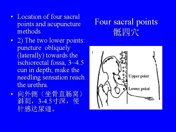  • Location of four sacral points and acupuncture methods • 2) The two