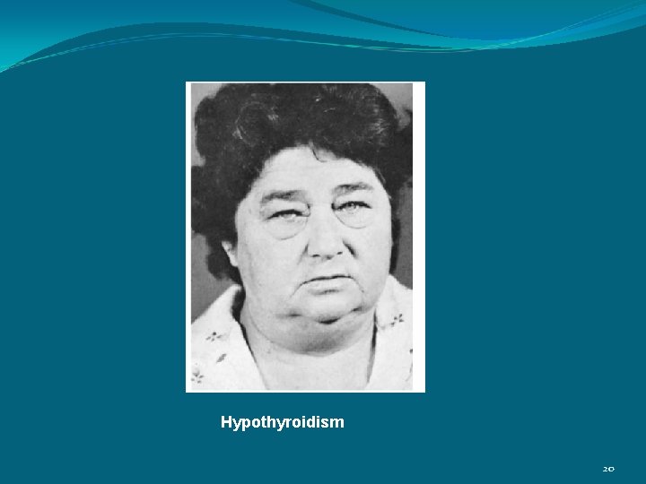 Hypothyroidism 20 