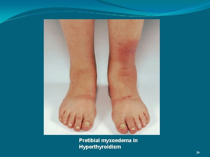 Pretibial myxoedema in Hyperthyroidism 39 