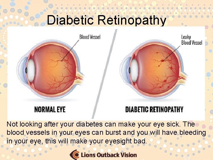 Diabetic Retinopathy Not looking after your diabetes can make your eye sick. The blood