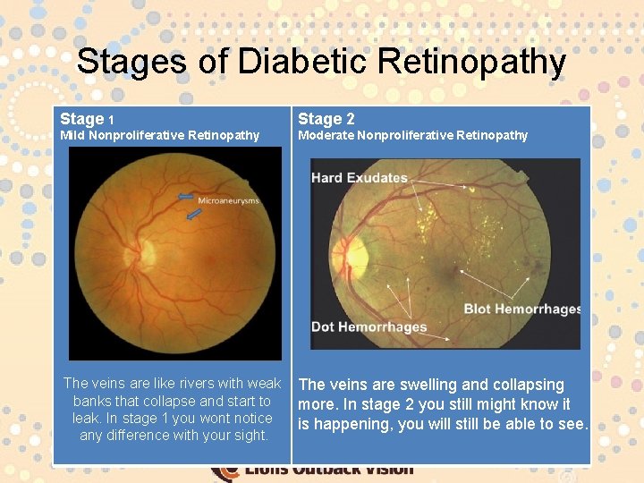 Stages of Diabetic Retinopathy Stage 1 Stage 2 Mild Nonproliferative Retinopathy Moderate Nonproliferative Retinopathy