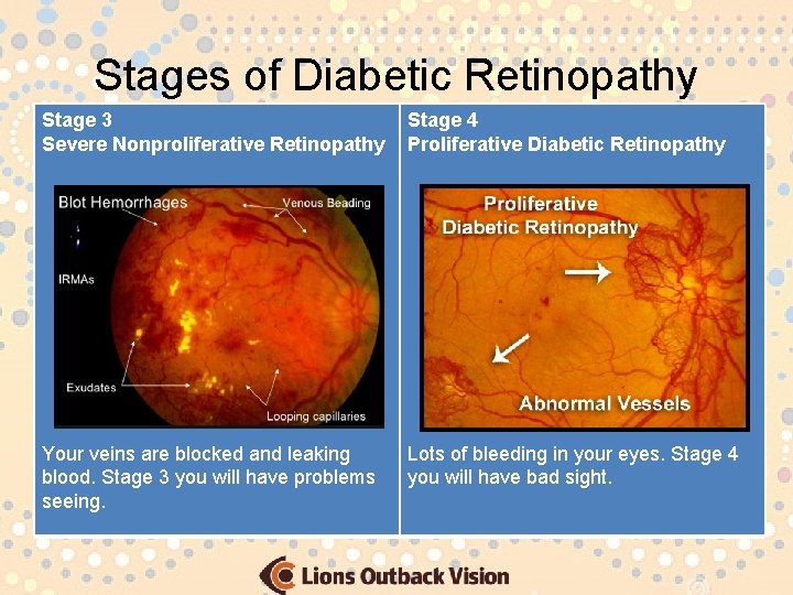 Stages of Diabetic Retinopathy Stage 3 Severe Nonproliferative Retinopathy Stage 4 Proliferative Diabetic Retinopathy
