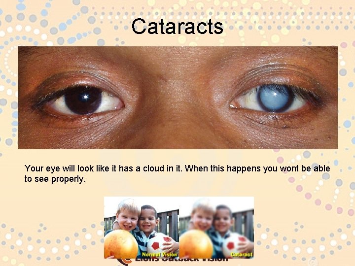 Cataracts Your eye will look like it has a cloud in it. When this