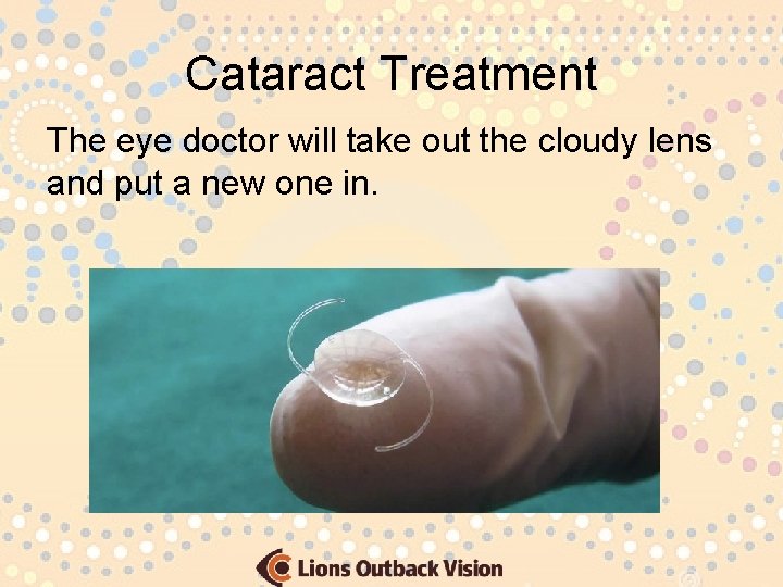Cataract Treatment The eye doctor will take out the cloudy lens and put a