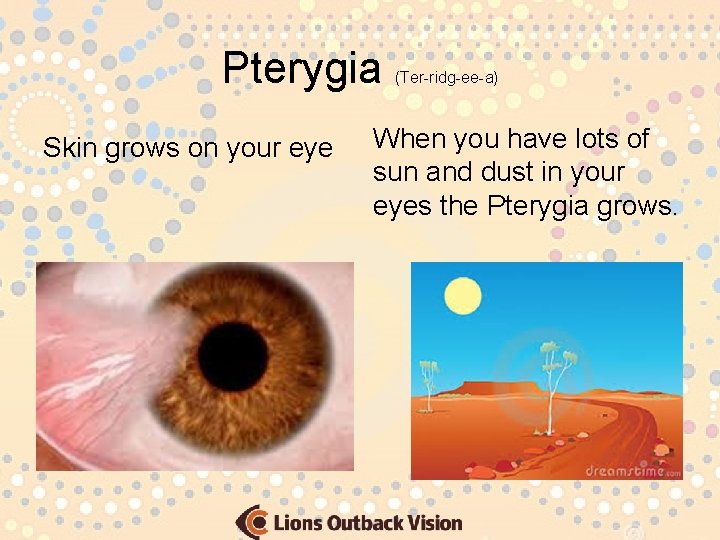 Pterygia Skin grows on your eye (Ter-ridg-ee-a) When you have lots of sun and