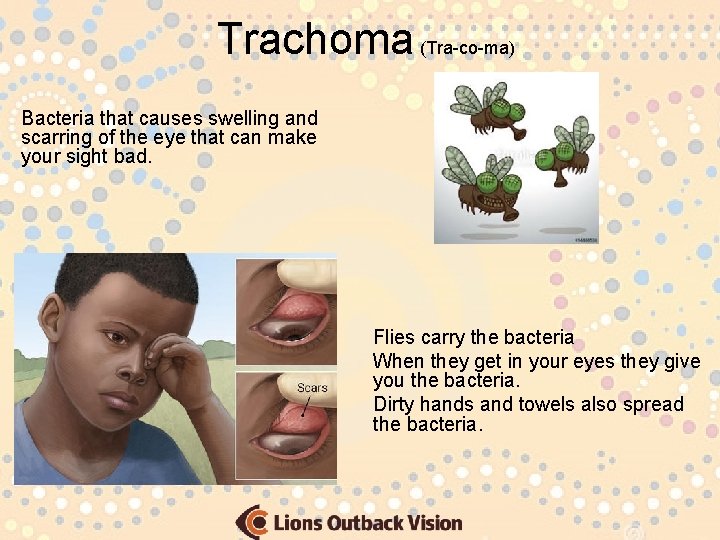Trachoma (Tra-co-ma) Bacteria that causes swelling and scarring of the eye that can make