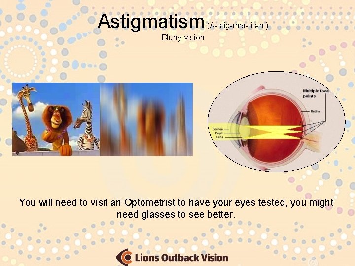 Astigmatism (A-stig-mar-tis-m) Blurry vision You will need to visit an Optometrist to have your