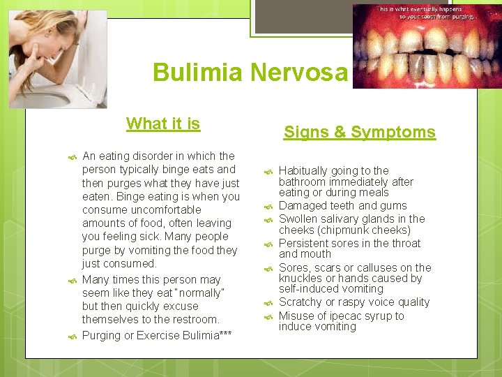 Bulimia Nervosa What it is An eating disorder in which the person typically binge