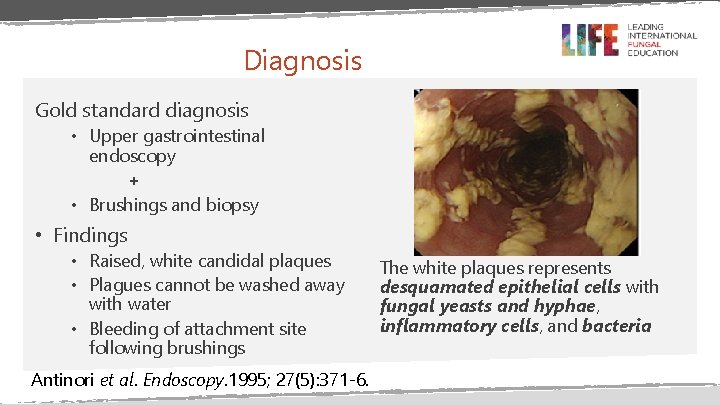 Diagnosis Gold standard diagnosis • Upper gastrointestinal endoscopy + • Brushings and biopsy •