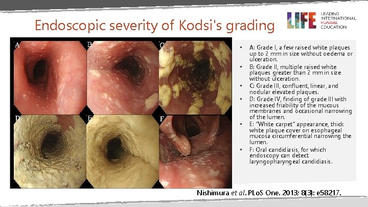 Endoscopic severity of Kodsi's grading • • • A: Grade I, a few raised