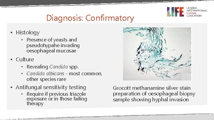 Diagnosis: Confirmatory • Histology • Presence of yeasts and pseudohypahe invading oesophageal mucosae •