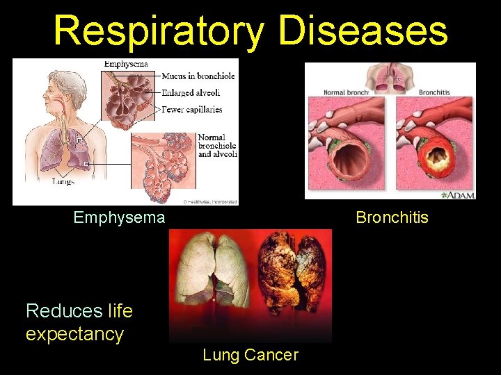 Respiratory Diseases Emphysema Bronchitis Reduces life expectancy Lung Cancer 